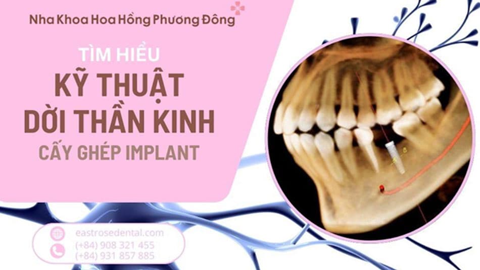 Kỹ Thuật Dời Thần Kinh - Giải Pháp Cho Các Ca Implant Khó