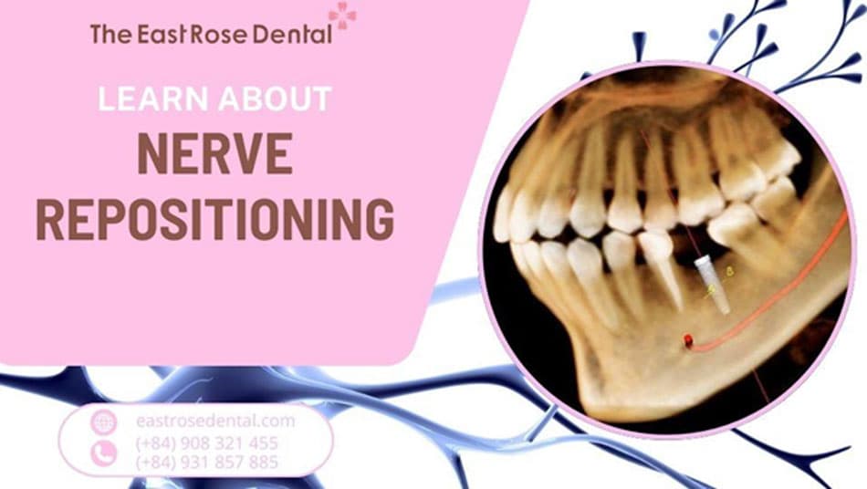 Nerve Repositioning - A Solution for Challenging Implants