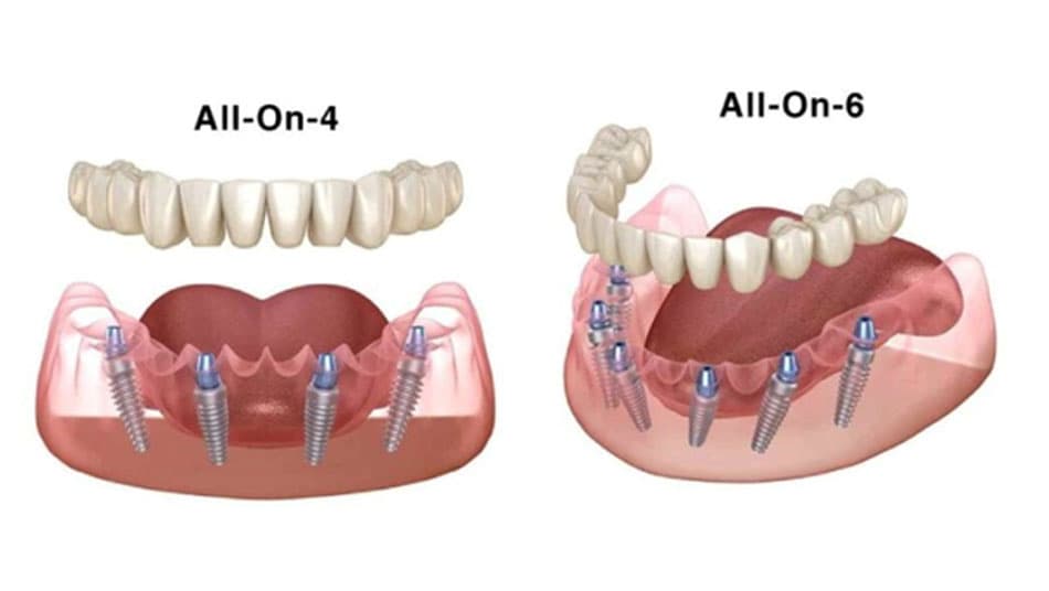 Nerve Repositioning Technique for Multiple Implant Placement