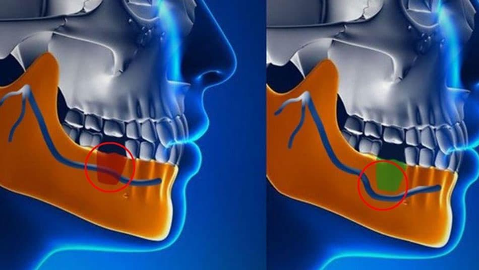 Special Cases Requiring the Nerve Repositioning Technique