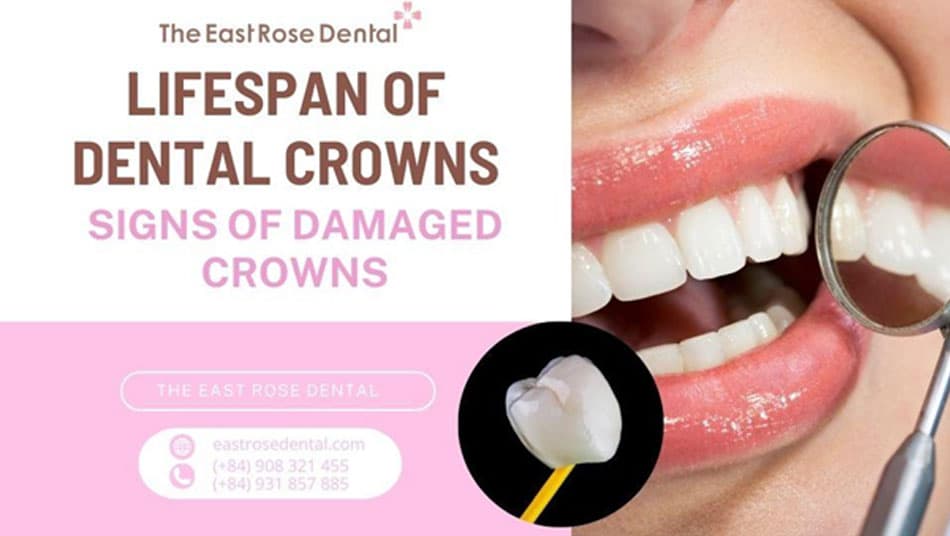 Lifespan of Porcelain Crowns and Common Signs of Damage