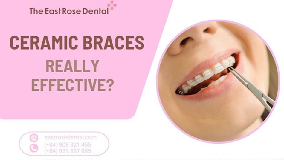 Are ceramic braces really as good as they are said to be?