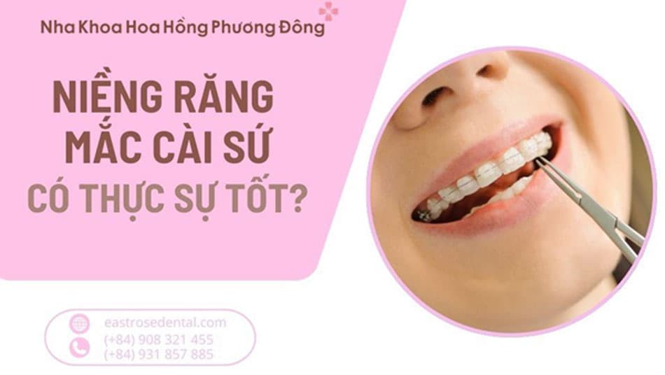   Niềng răng mắc cài sứ có thực sự tốt như lời đồn?