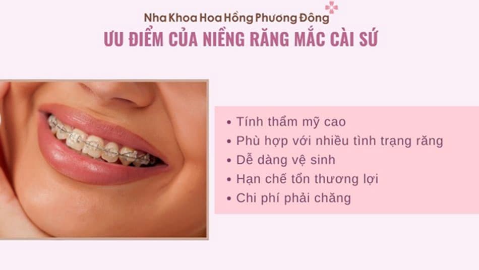 Niềng răng mắc cài sứ mang lại tính thẩm mỹ cao