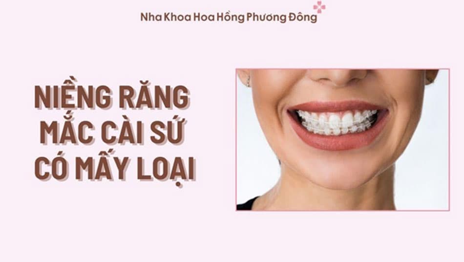 Niềng răng mắc cài sứ thẩm mỹ tự đóng là phương pháp hiện đại nhất