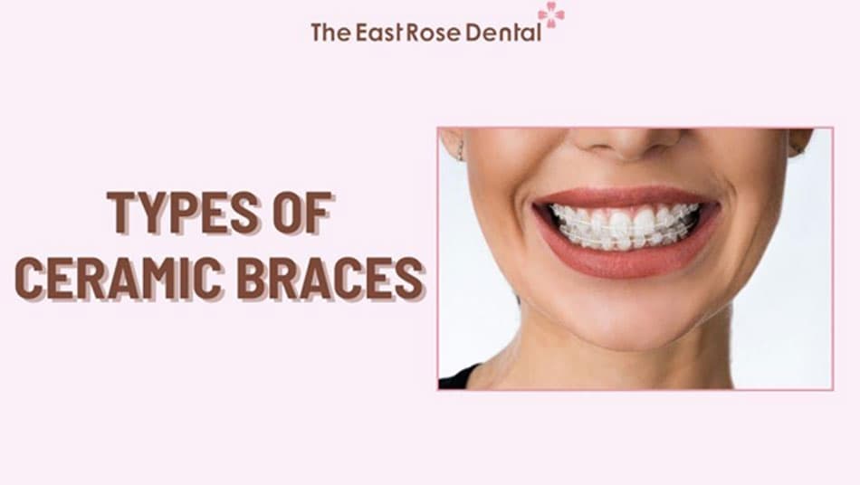 Self-ligating aesthetic ceramic braces are the most advanced method