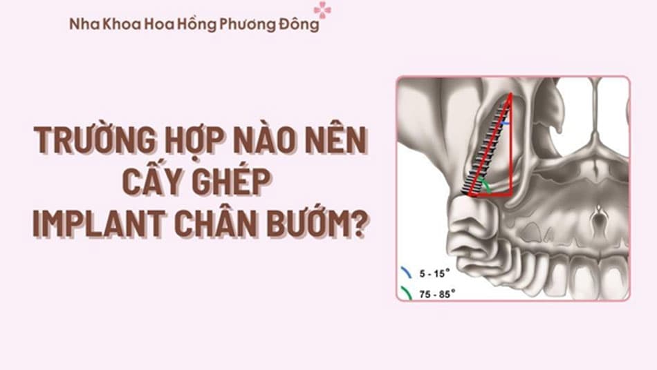 Cấy ghép Implant chân bướm chỉ phù hợp với một số trường hợp nhất định