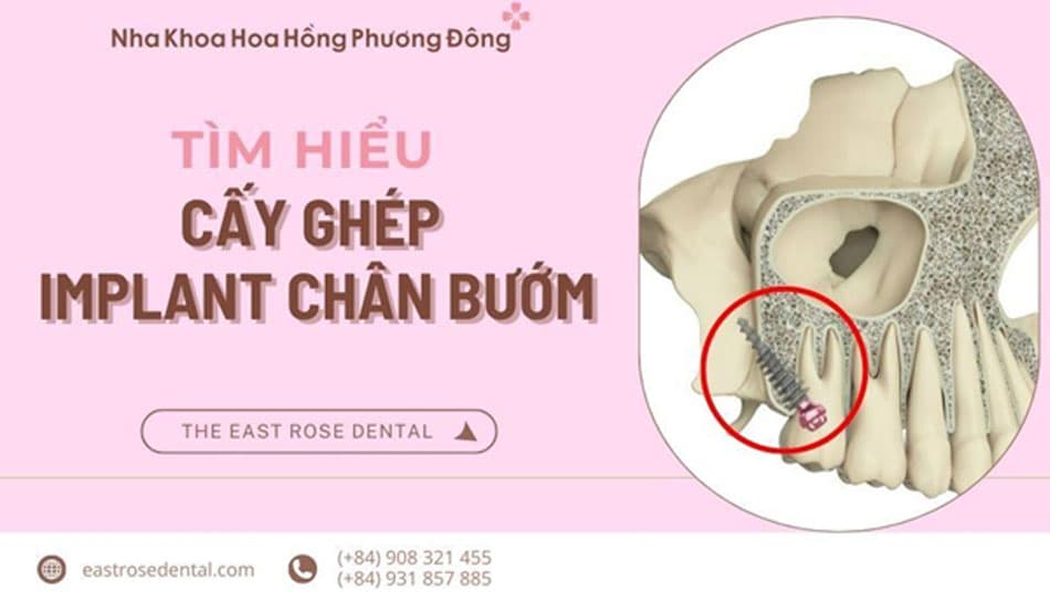 Implant Chân Bướm Và Những Trường Hợp Nên Cấy Ghép
