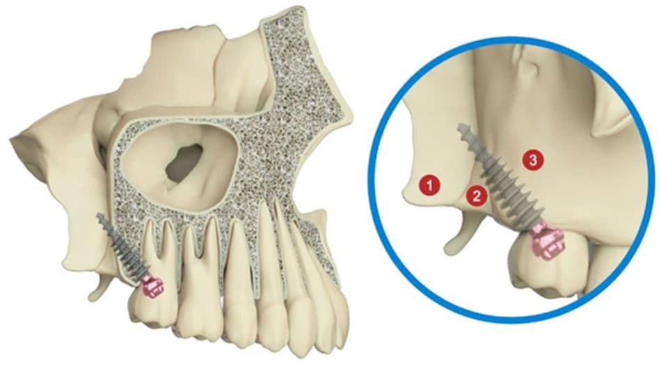 Pterygoid Implant Offer Outstanding Benefits