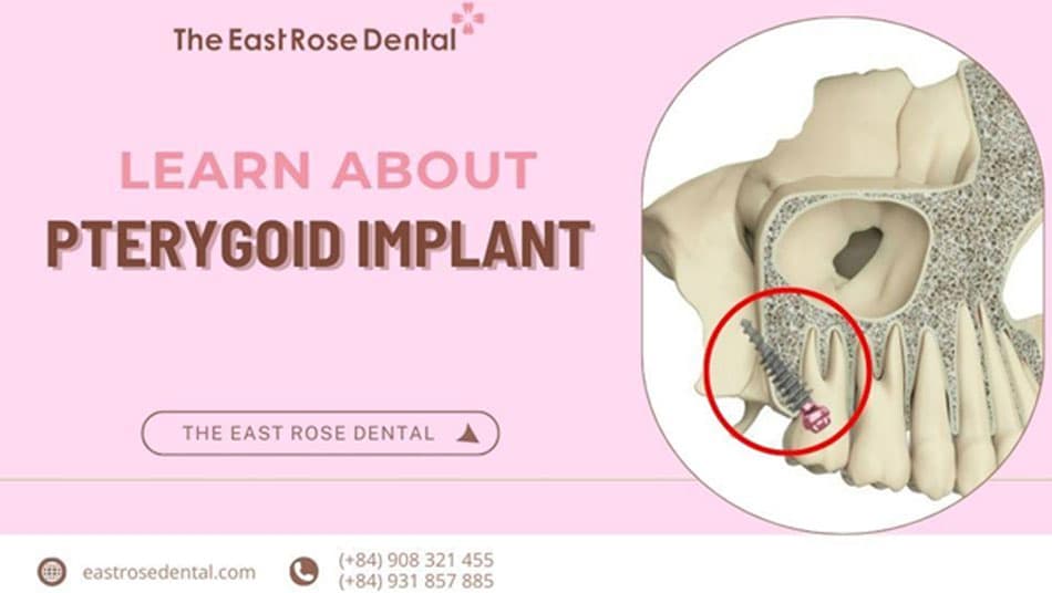 Pterygoid Implant and Cases Where Implantation Is Advised