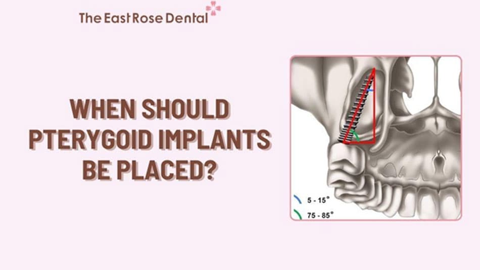 Pterygoid implant is only suitable for specific cases