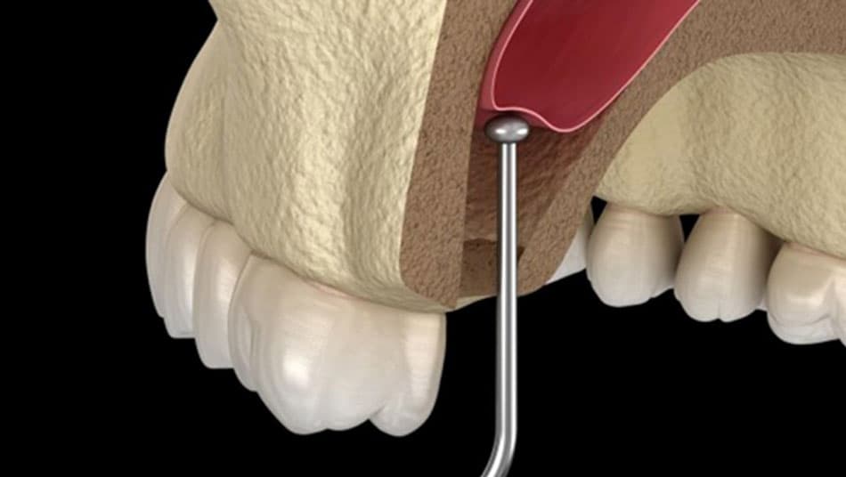 Sinus lift is not feasible or not recommended