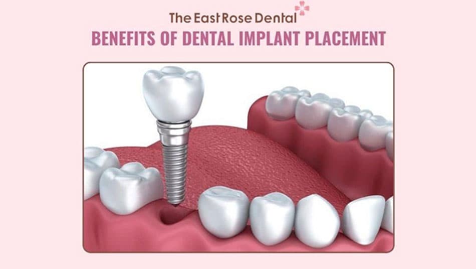 Dental implants offer outstanding benefits
