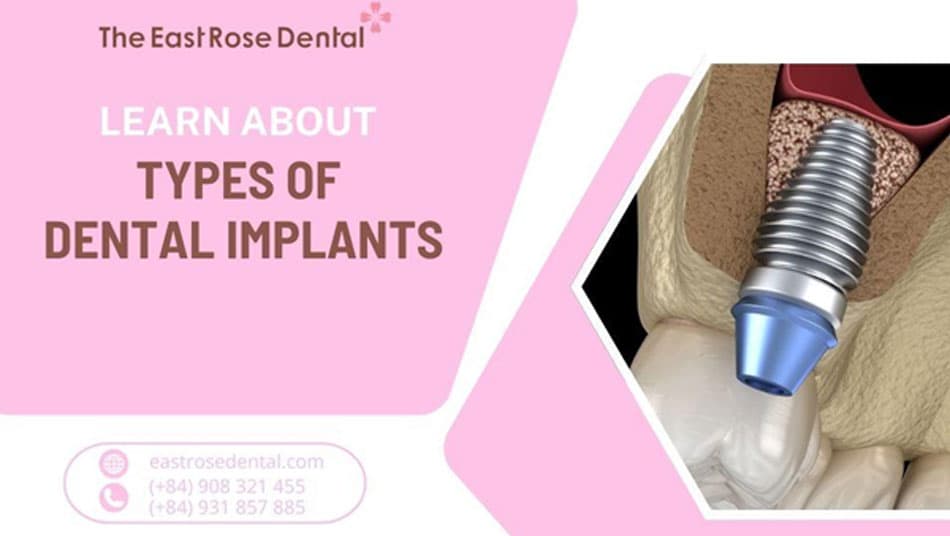 Exploring Dental Implants: Which Option Suits You Best?