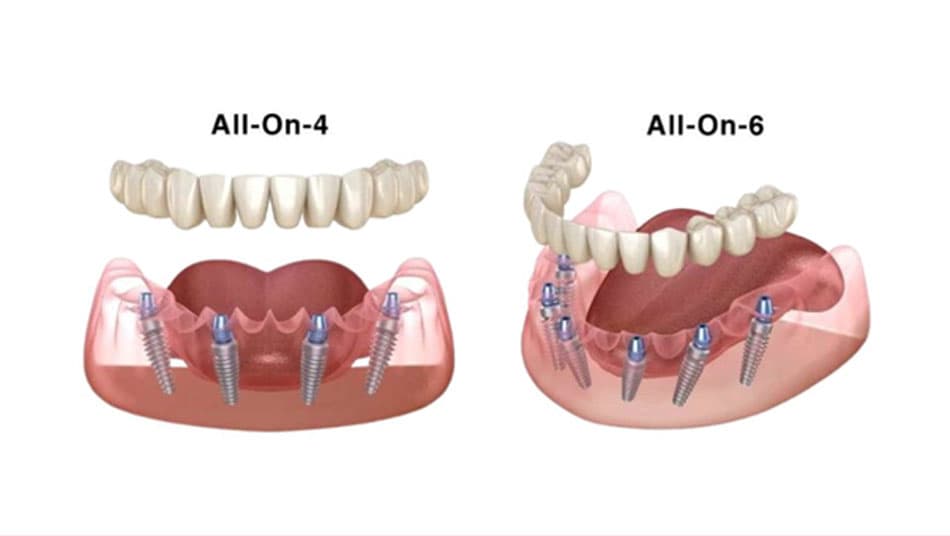 Implant all-on-4/6 is an advanced method widely used
