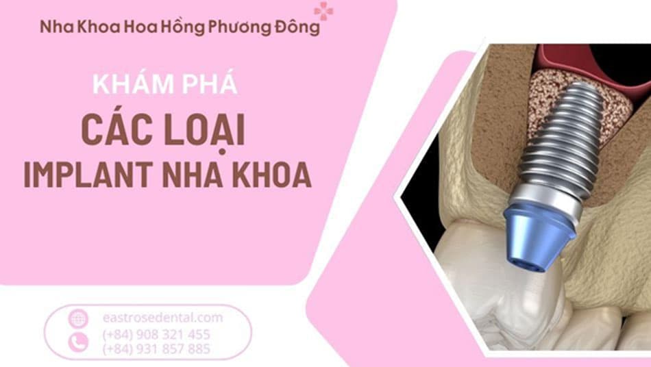 Khám Phá Các Loại Implant Nha Khoa: Giải Pháp Nào Phù Hợp?