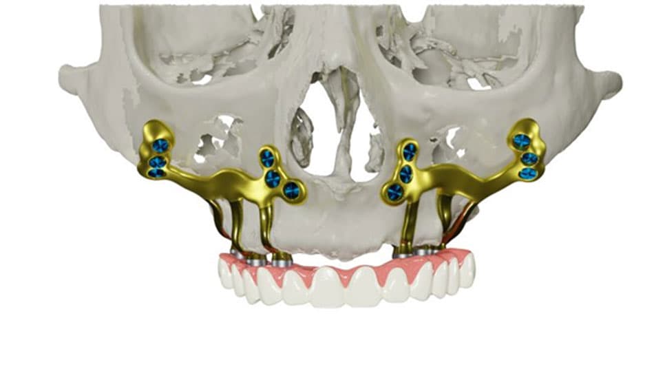 Subperiosteal implants help reduce treatment time