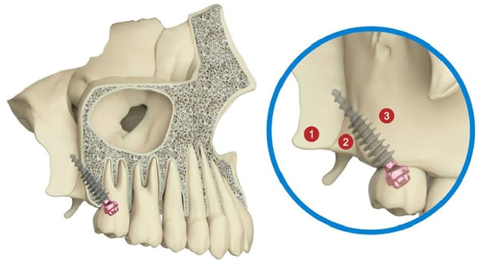 Zygomatic implants restore lost teeth in a sustainable manner