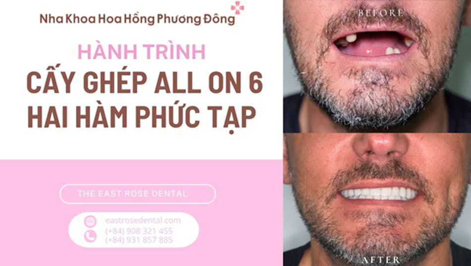Điều Trị Dời Dây Thần Kinh & Cấy Ghép Implant Toàn Hàm