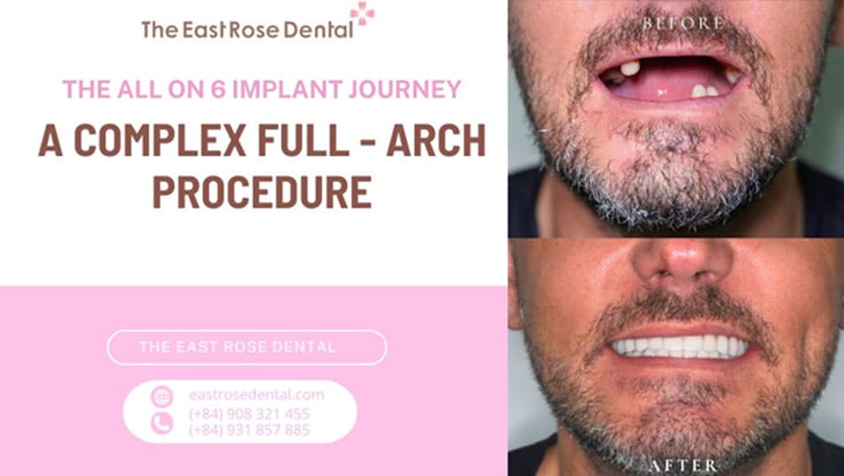 Nerve Repositioning and Full-Arch Implant Treatment