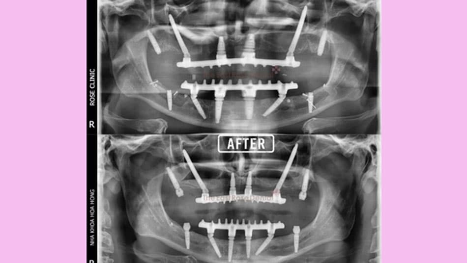Performed nerve repositioning, lower jaw bone grafting, and placed a total of 12 implants
