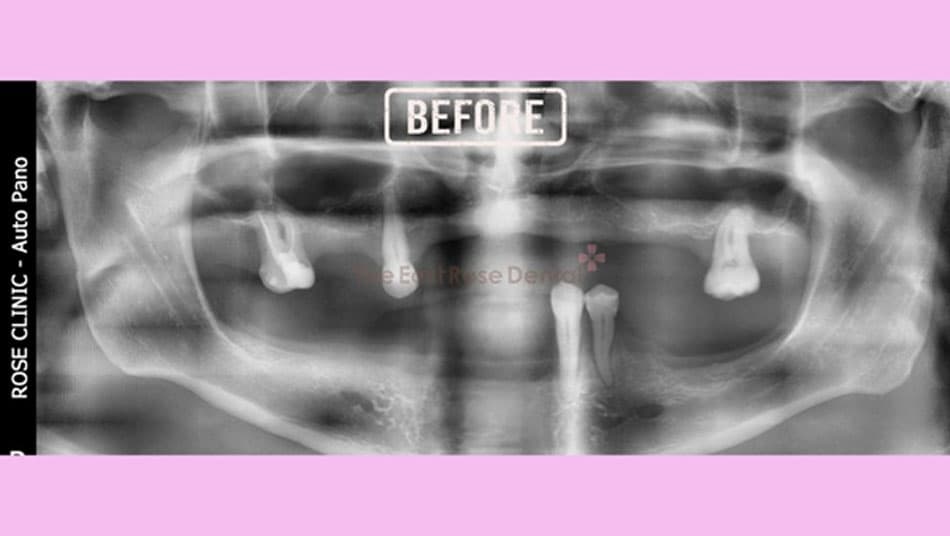 The client's initial tooth loss and bone loss status