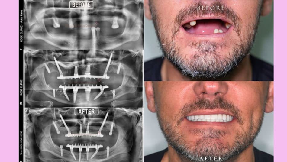 The patient's journey to restoring his smile after years of tooth loss and bone resorption