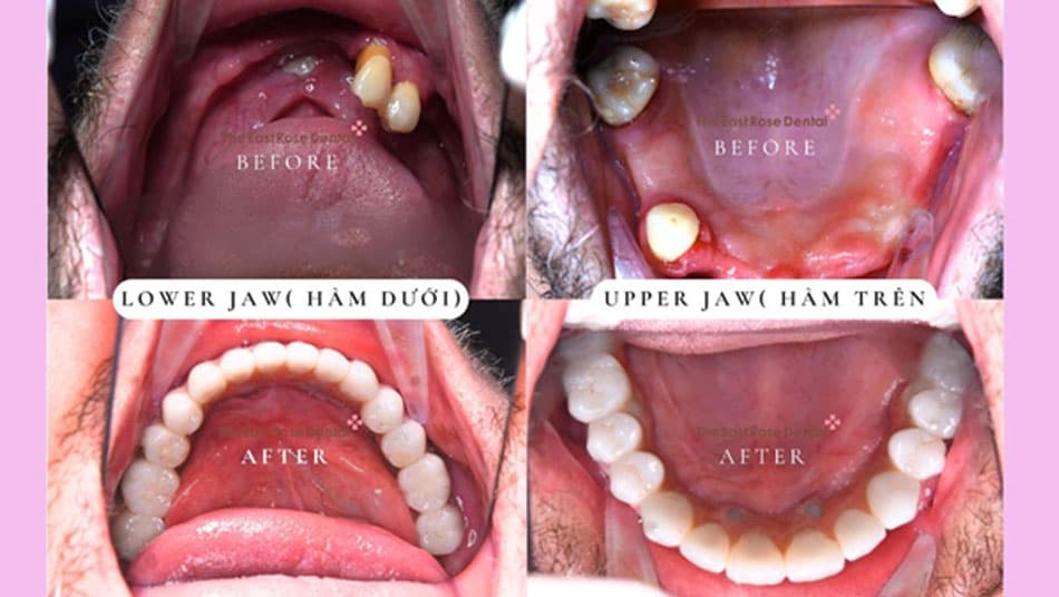 The patient regained aesthetics and chewing function after implant treatment