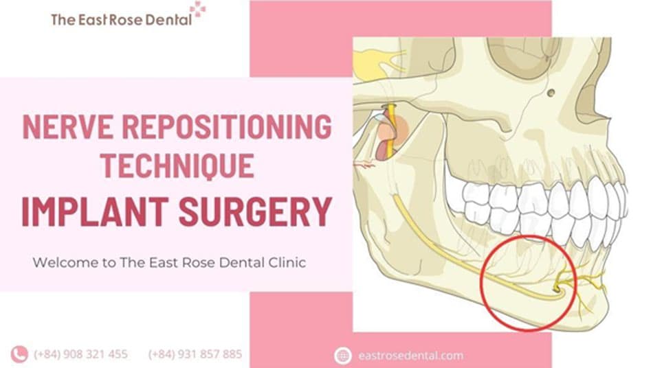 Explore Nerve Repositioning Technique in Implant Surgery