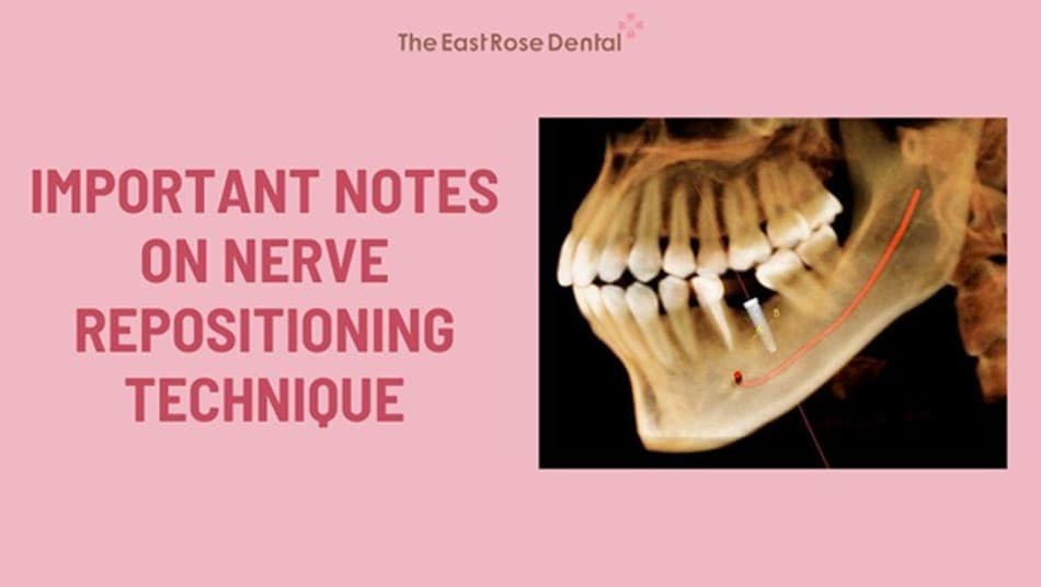 Important considerations for nerve repositioning technique