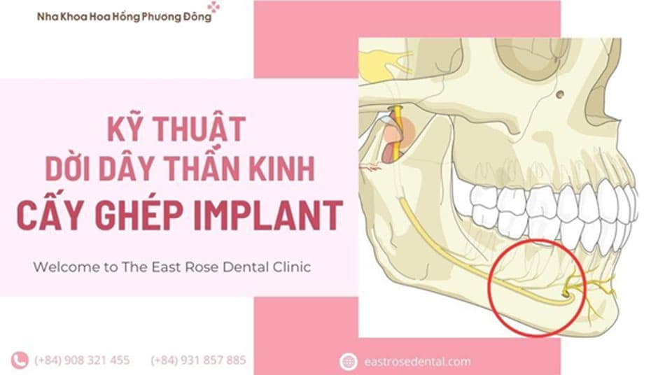Khám Phá Kỹ Thuật Dời Dây Thần Kinh Trong Cấy Ghép Implant