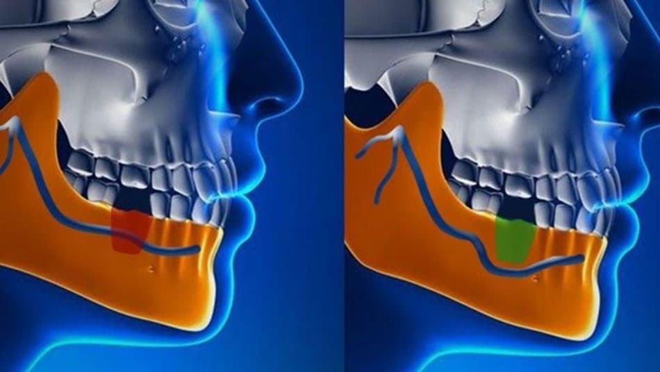 The nerve repositioning technique is only performed when absolutely necessary
