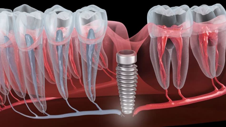The nerve repositioning technique requires a thorough evaluation of various factors