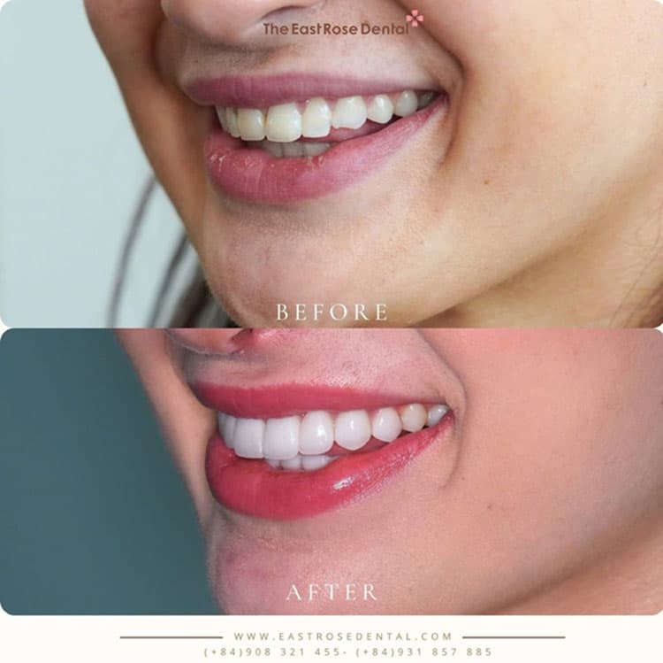 Porcelain Veneer Transformations at The East Rose Dental Clinic