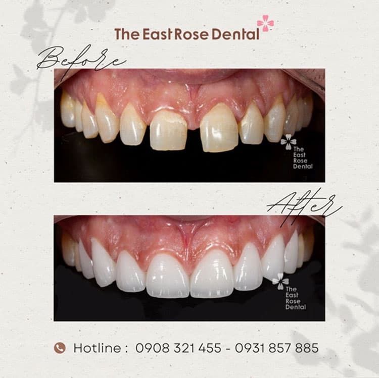 Porcelain veneers improve the condition of gapped and discolored teeth