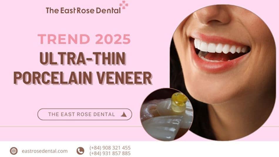 Porcelain Veneers - The Hot Trend of 2025 for a Perfect Smile