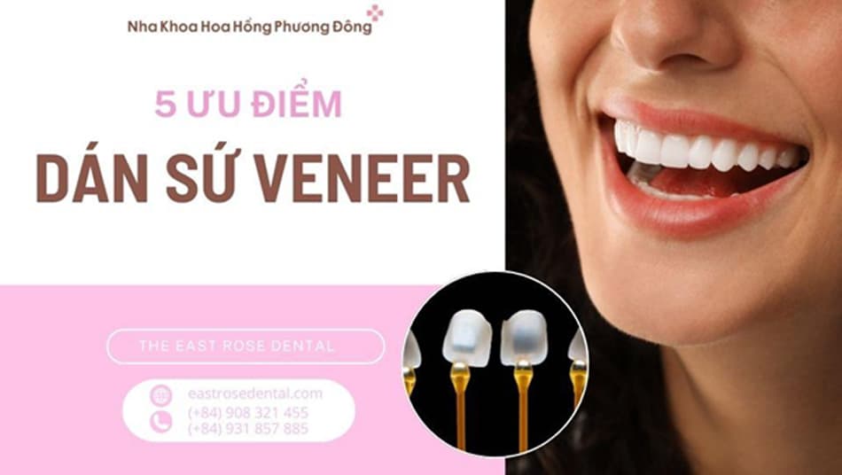 5 Ưu Điểm Vượt Trội Của Dán Sứ Veneer Siêu Mỏng