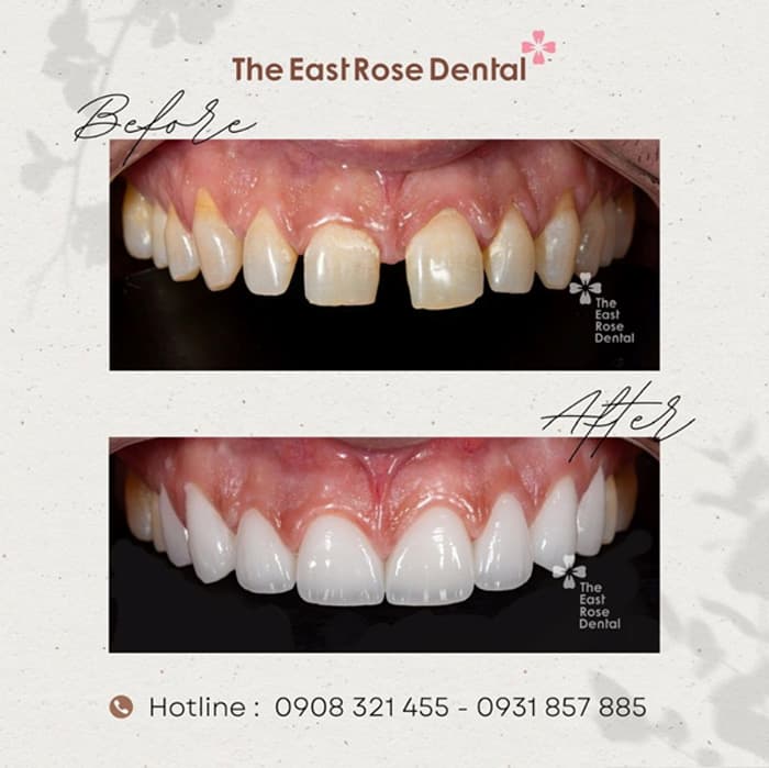 Porcelain Veneers Perfectly Correct Imperfections