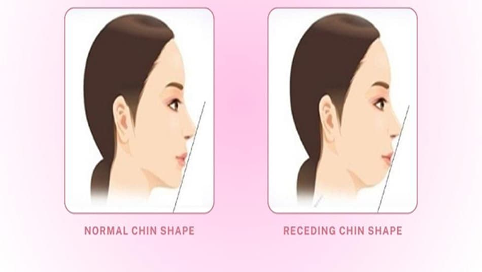 5 common causes of a receding chin