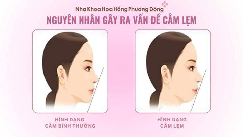 5 nguyên nhân phổ biến gây ra tình trạng cằm lẹm