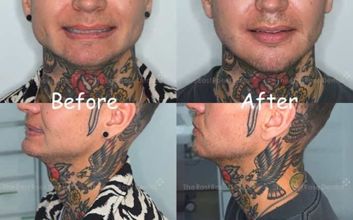Chin Retrusion Surgery Results 