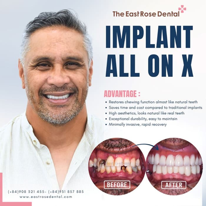 All-on-4 implants provide high aesthetic value, resembling natural teeth