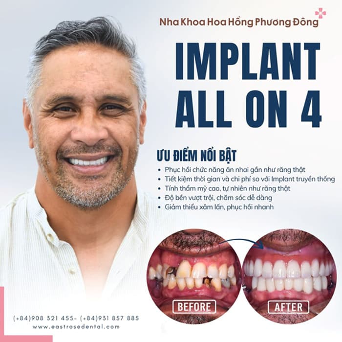 Cấy ghép All On 4 mang lại tính thẩm mỹ cao như răng thật
