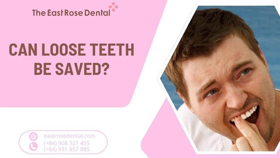 Can loose teeth be saved? Effective and lasting solutions
