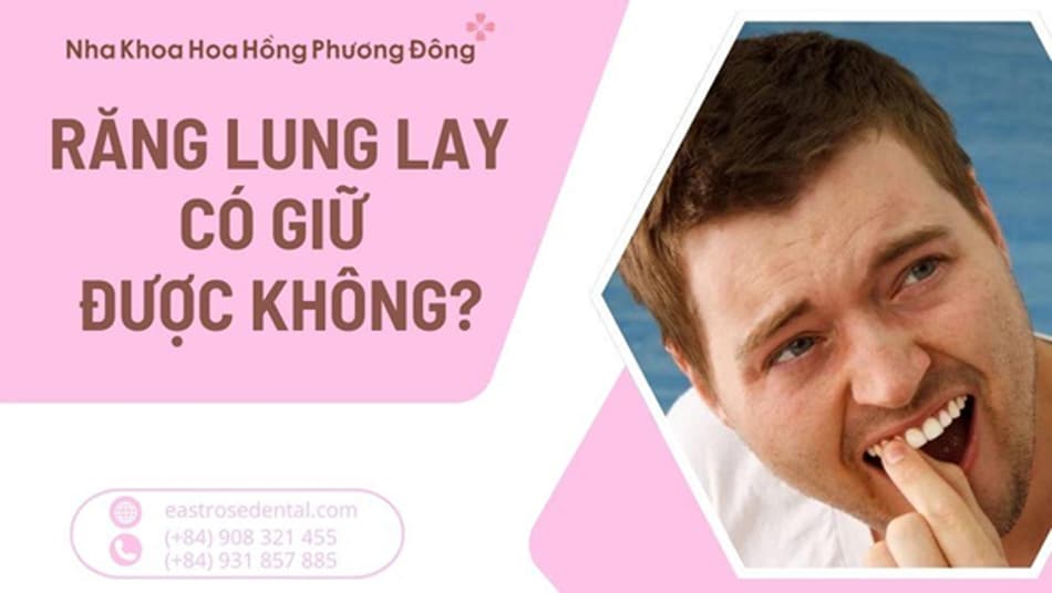 Răng lung lay có giữ được không? Giải pháp hiệu quả