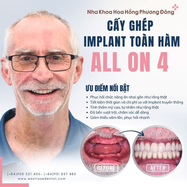Phục hình All On 4/6 là dịch vụ nổi bật tại Nha Khoa Hoa Hồng Phương Đông