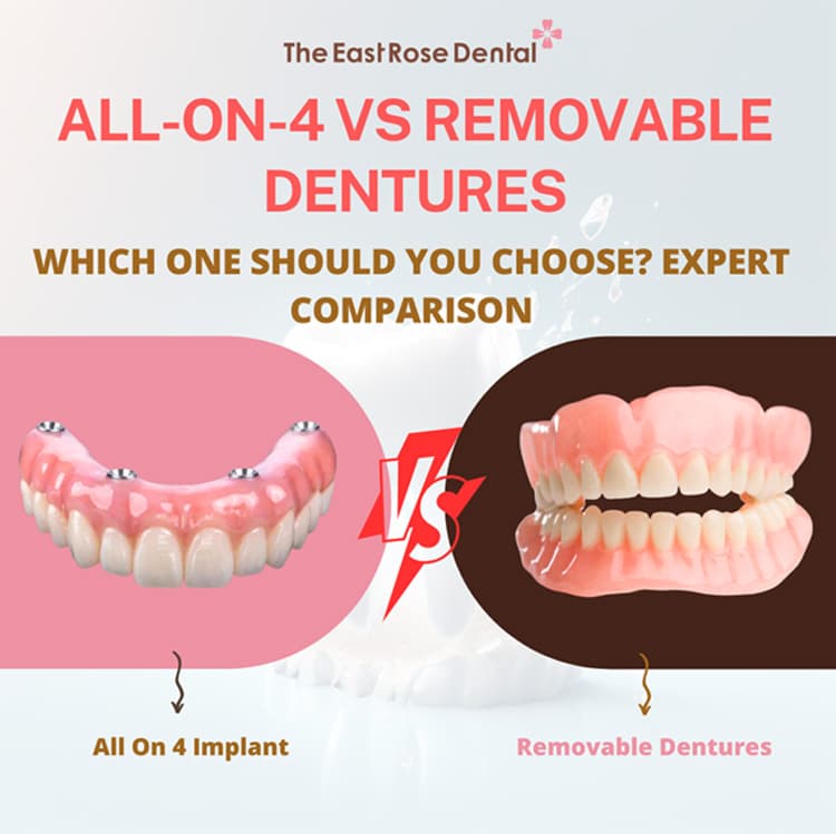 All-on-4 vs Removable Dentures: Which One Should You Choose? Expert Comparison