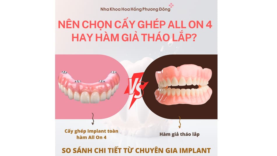 Nên chọn All-on-4 hay hàm giả tháo lắp? So sánh chi tiết từ chuyên gia Implant
