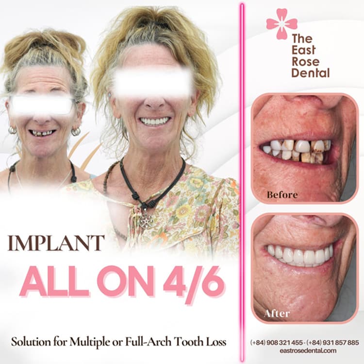 All on 4 can be done without bone grafting