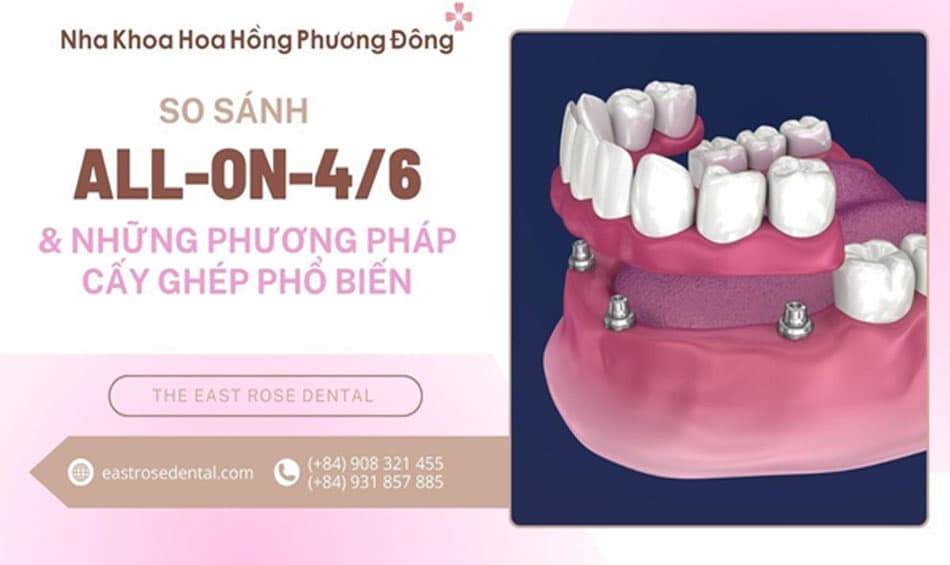 So sánh giữa All-on-4/6 và những phương pháp cấy ghép phổ biến